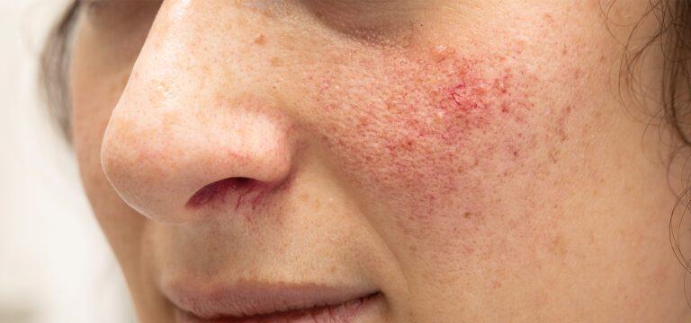 Rosacea and Hymed